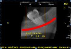 15 2.2 TOMOGRAFIA COMPUTADORIZADA As radiografias panorâmicas apresentam as relações do terceiro molar com estruturas nobres como o canal do nervo mandibular, a extensão das raízes e graus de