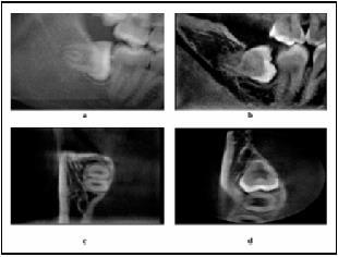 16 O cirurgião buco-maxilo-facial deve olhar para certos sinais na radiografia panorâmica para avaliar a relação entre o canal do nervo mandibular e as raízes do 3MI.
