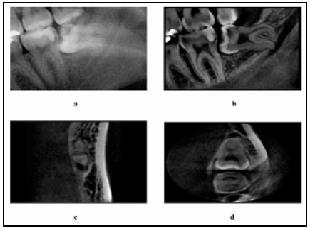 17 Figura 4 Radiografia panorâmica mostrando parede do canal intacta (a) e imagens de TC (b, c, d) da mesma paciente mostrando que existe contato direto entre o 3MI e o canal mandibular