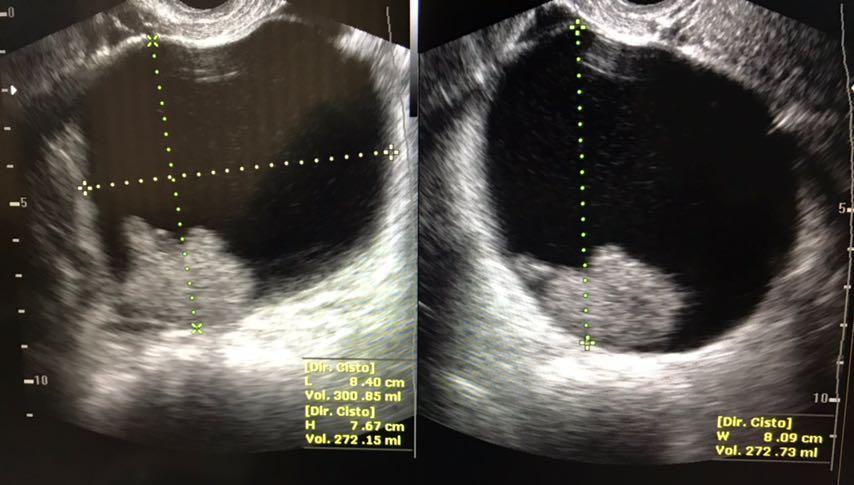 Figura 1: Ultrassonografia transvaginal Fonte: Cedida por Dra Eliza Mattos Tinoco Ressonância magnética de abdome e pelve evidenciou lesão expansiva com sinal heterogêneo ocupando o anexo direito com