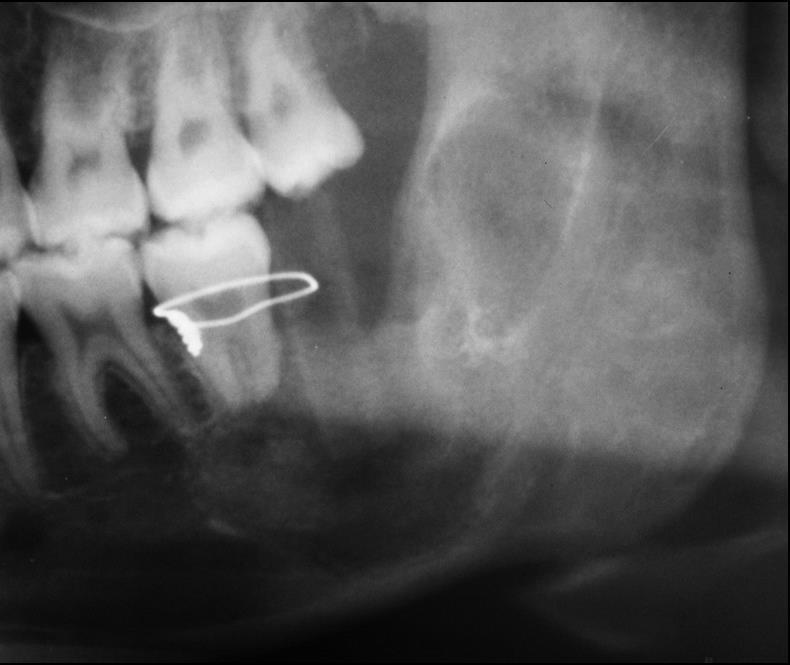 O protocolo de tratamento adotado foi enucleação associada à ostectomia periférica, com remoção de 2mm de osso a partir das margens ósseas visíveis da lesão.