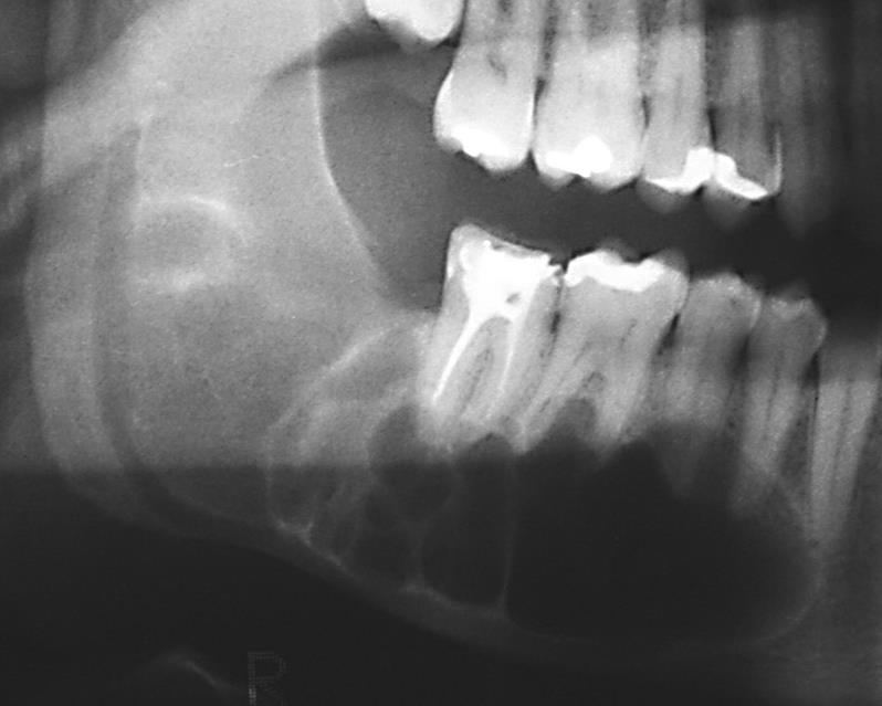 Odontogênico: A) unilocular B)