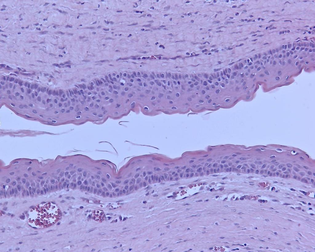 38 Figura 8 - Fotomicrografia de lesão de Ceratocisto Odontogênico mostrando paraqueratinização no revestimento