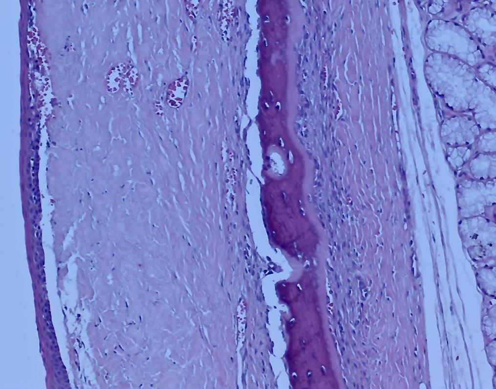 39 Figura 9 - Fotomicrografia de Ceratocisto Odontogênico evidenciando a presença de fenda na interface epitélio/cápsula do revestimento cístico (lado esquerdo) e ainda a presença de cortical óssea