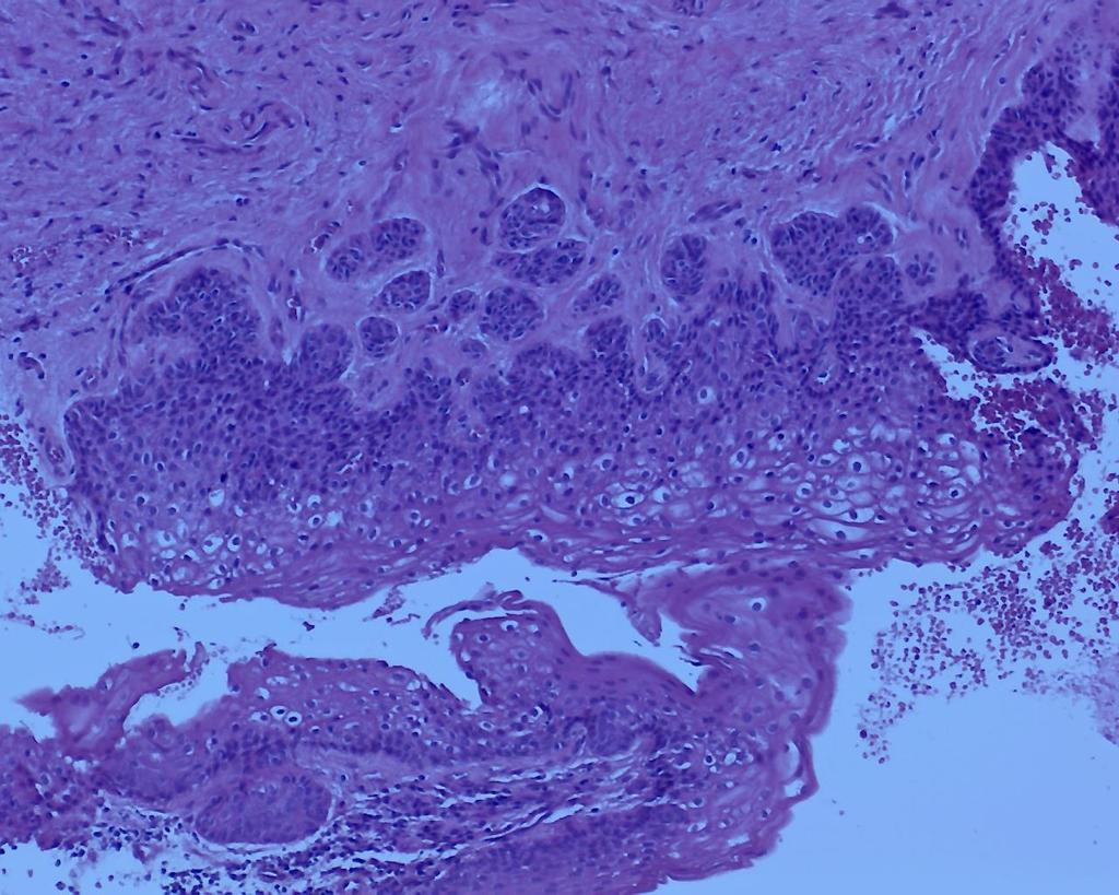 41 Figura 11 - Fotomicrografia de Ceratocisto Odontogênico mostrando a presença de ninhos/ilhas epiteliais na cápsula fibrosa do revestimento cístico - Coloração em Hematoxilina e