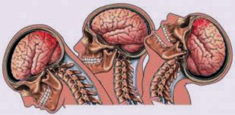 URGÊNCIAS E EMERGÊNCIAS CIRÚRGICAS Um neurônio possui uma parte mais pesada, dita corpo, e uma parte mais leve, denominada axônio.