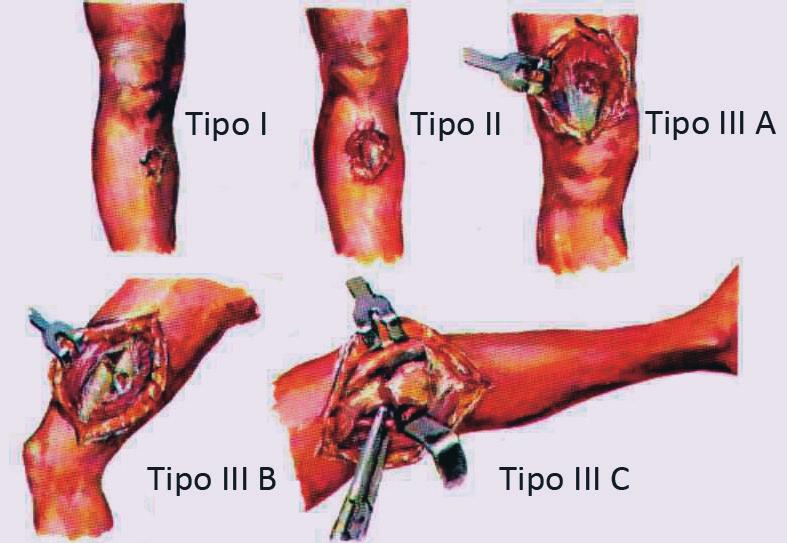 IIIa - >10 cm; IIIb - >10 cm e, não sendo possível fechar a lesão primariamente, é necessário retalho; IIIc - >10 cm e necessidade de um reparo vascular Nesses casos, a conduta