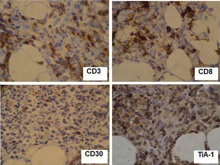 Linfoma subcutâneo de células T paniculite-símiles 417 A FIGURA 2: Denso infiltrado inflamatório com frequentes linfócitos atípicos de tamanho pequeno a intermediário na derme profunda e tecido