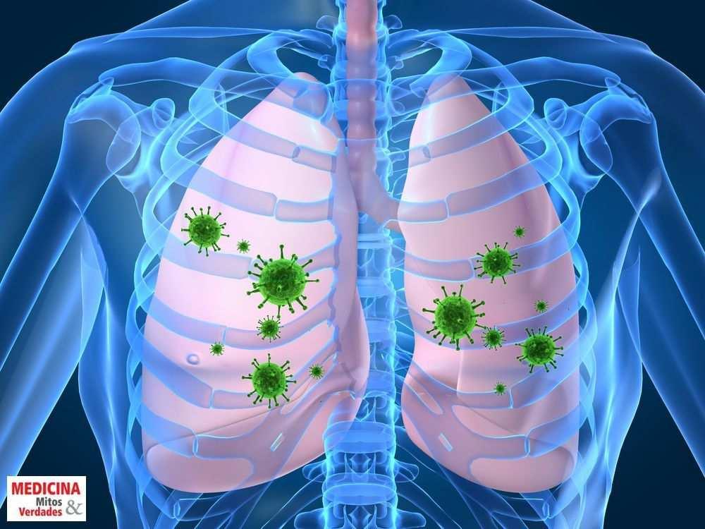 Pneumonia e meningite - Pneumonia: - infecções pulmonares em que os alvéolos (estrutura pulmonar onde ocorrem as trocas gasosas) se enchem de pus (líquido espesso formado no local de uma infecção ou
