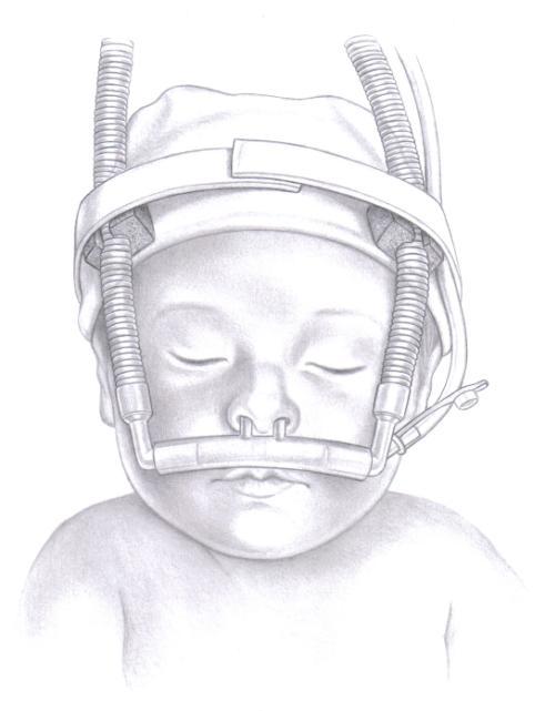 21 CPAP Nasal Infantil BABY VENT CPAP infantil com cânula nasal em silicone Kit para CPAP nasal infantil completo para administração de fluxo contínuo de ar através de ventilação mecânica não