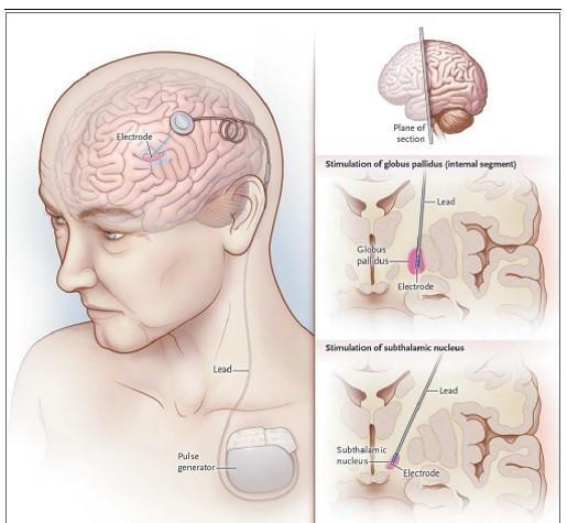 Estimulação Cerebral Profunda Descarga de pulsos elétricos no Núcleo Subtalâmico ou Globo Pálido Interno ajudam a manter o