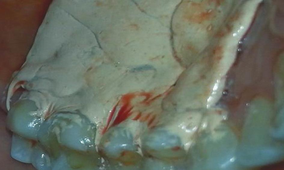 Após uma semana, o cimento cirúrgico foi removido e observou-se que as áreas cirúrgicas apresentavam uma evolução de cicatrização satisfatória e sem sinais de necrose do enxerto ou eventos adversos.
