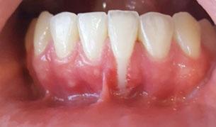 dentária a trauma oclusal associado à vestibularização do dente 31.