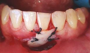 Prévio ao procedimento cirúrgico, a paciente recebeu instruções de higiene bucal atraumática, além de raspagem e alisamento radicular em ambas as arcadas, profilaxia e orientação de higiene bucal