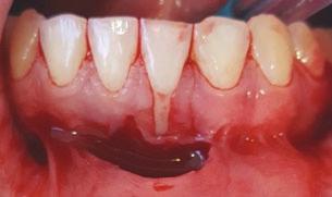 Também foi realizado um retalho de espessura parcial com incisões relaxantes a partir da distal do dente 32 até a mesialdo 31, por meio de incisão horizontal nas papilas interproximais ao nível da