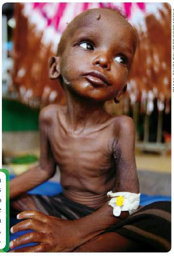 A fome Subnutrição aguda: duas formas clínicas