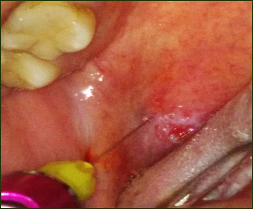 No exame intraoral observou-se uma úlcera, localizada em palato mole (Figura 1) de aproximadamente 4 cm de diâmetro, de bordas irregulares