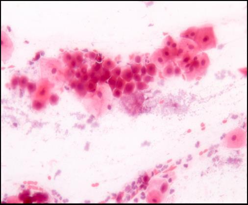 Figura 4: Mensuração da amostra obtidas. Figura 6: Células inflamatórias em lâmina própria (HE). Fonte: Imagem cedida pelo laboratório SEPAT-UEA.
