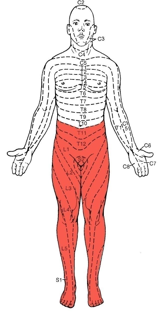 Paraparesia