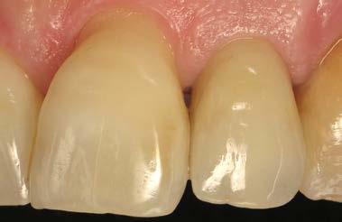 dentes vizinhos, com a sua cor base forte e seus efeitos de esmalte.