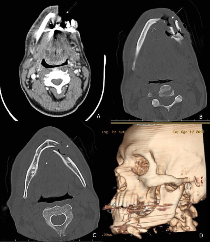 Figura 2. Tomografia computadorizada de face. Fratura de mandíbula com perda significativa de partes moles (A). Fratura cominutiva de mandíbula com diversos fragmentos ósseos (B).