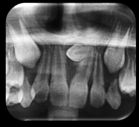 19 Os dentes supranumerários podem ser os responsáveis por várias alterações nas dentições decídua e mista, como alterações na oclusão, na erupção, causando giroversão de outros dentes,