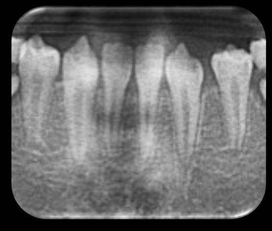 20 2.2.1.2 Hipodontia Hipodontia é definida como a ausência congênita de um ou poucos dentes (Fig. 2), e é também a anomalia mais comum do desenvolvimento dental.