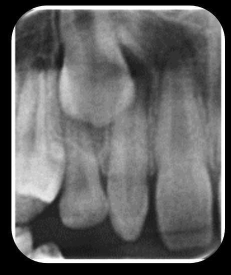 23 Cerca de 35 a 55% dos pacientes com SD apresentam microdontia tanto na dentição decídua quanto na permanente.