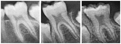 taurodontismo nesta condição. A dentição de 19 pacientes (55%) apresentou-se taurodôntica.