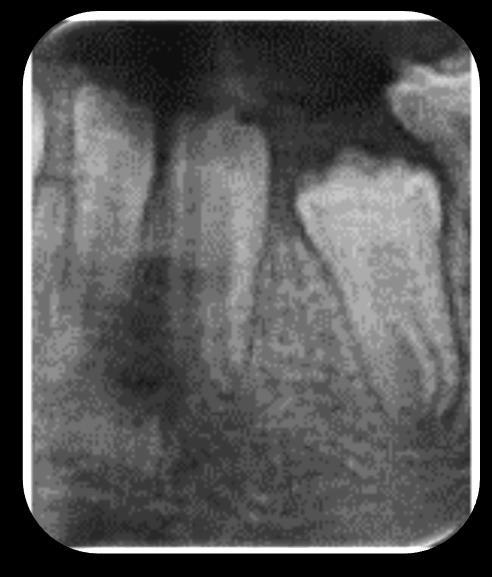 28 Fig. 7 Fusão (32 e 33 fusionados) Com o intuito de avaliar a incidência das anomalias dentárias de desenvolvimento em uma amostra de pacientes com SD, Marques et al.