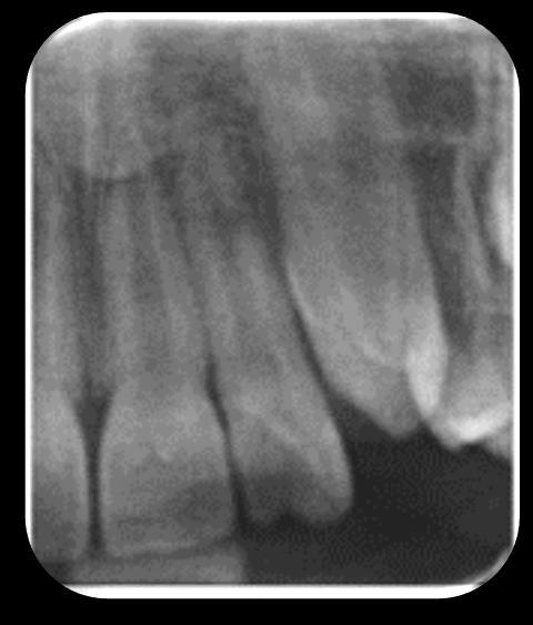 29 A presença de dente duplo (geminação ou fusão) na dentição decídua pode resultar em apinhamento, espaçamento anormal e erupção ectópica ou retardada dos dentes permanentes subjacentes, podendo-se