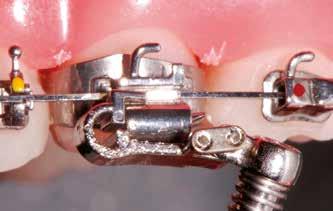 Requerimentos clínicos para instalação do Forsus Como o Forsus, assim como todos os propulsores mandibulares, tende a projetar os dentes inferiores, o ideal é reforçar a ancoragem nessa arcada.