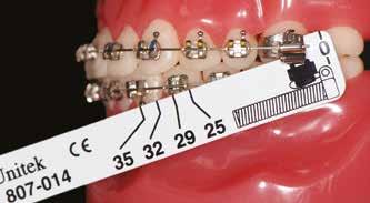 Para evitar a protrusão dos incisivos inferiores, pode-se incrementar, no arco, torque resistente lingual de coroa nos dentes anteroinferiores ou utilizar uma prescrição de braquetes com maior torque