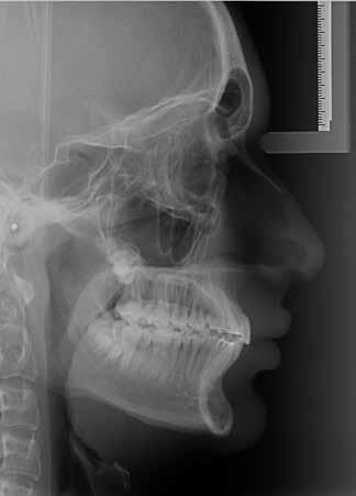 B) Sobreposição maxilar (ENA-ENP com registro em