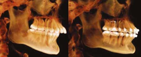 TRATAMENTO COMPENSATÓRIO DA CLASSE II Muitos pacientes adultos que possuem retrusão mandibular e apresentam indicação para o tratamento cirúrgico preferem não fazer a cirurgia ortognática.