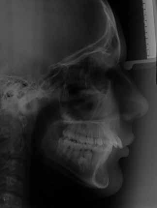 A remoção tardia do aparelho pode prevenir o pequeno crescimento mandibular e melhorar a maturidade da matriz do osso recém-formado no mesmo grau que o osso formado durante o desenvolvimento
