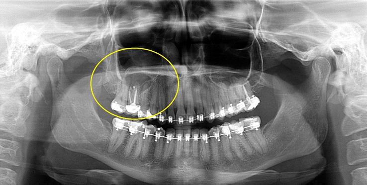 Imagem radiolúcida, circunscrita, de limites definidos e corticalizados, unilocular, envolta por halo radiopaco, possivelmente associada ao dente 16 (notar