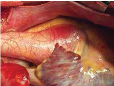 16 FIGURA 3: aneurisma sifilítico da aorta. Fonte: http://www.scielo.org.mx/scielo.php?
