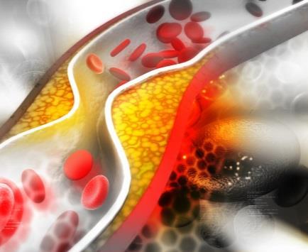 Nutracêutico e Colesterol Ação Coadjuvante na Redução Hipercolesterolemia O metabolismo lipídico pode ser alterado de várias maneiras, levando a modificações na função e/ou níveis das lipoproteínas