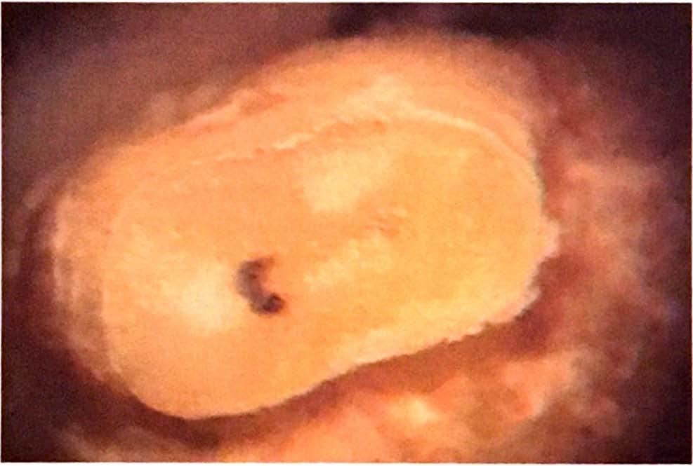 figura 1: Radiografia com hmas inseridas em toda a extensão do canal principal e até onde tosse passivei no quarto canal da raiz mesio-vest1bular.