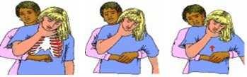 23 Manobra de Heimlich Coloque-se atrás da pessoa. Ponha os braços à volta da cintura da pessoa. Incline a pessoa ligeiramente para frente; Feche o punho de uma mão.