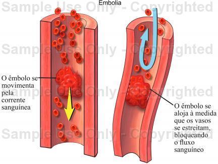 OBS.:Na tromboflebite existe o risco de ocorrer o desprendimento de um coágulo que pode alojar-se no pulmão ou cérebro, ocorrendo, nesse caso, embolia pulmonar ou cerebral,