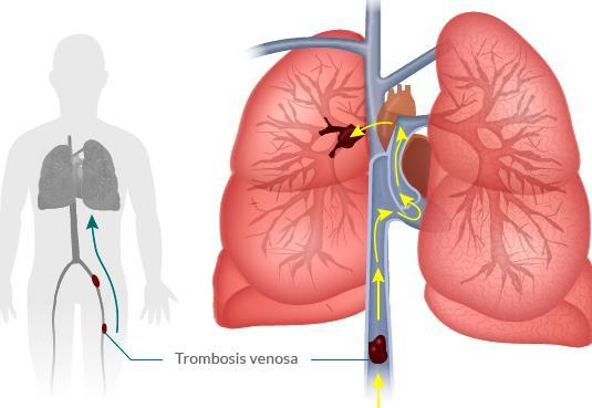 Complicações Vasculares/Circulatórias Embolia Pulmonar É uma complicação muito comum em cirurgias cardíacas e vasculares.
