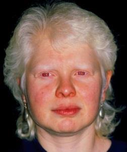Hereditariedade autossómica Albinismo: um exemplo de doença hereditária transmitida por