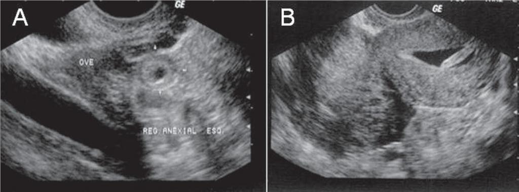 Figura 1 Aspectos ultrassonográficos de gravidez ectópica. A: Sinal do anel tubário (saco gestacional no anexo). B: Massa anexial. Fonte: Rios (2010).