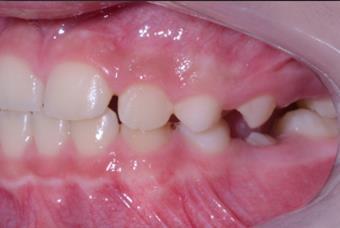 A linha média dentária inferior apresentava desvio de 3 mm para a esquerda.