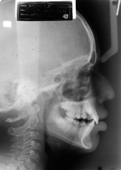 Figura 1 Radiografia Cefalométrica em norma