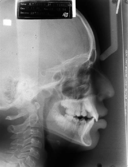 Figura 2 - Radiografia Cefalométrica em norma
