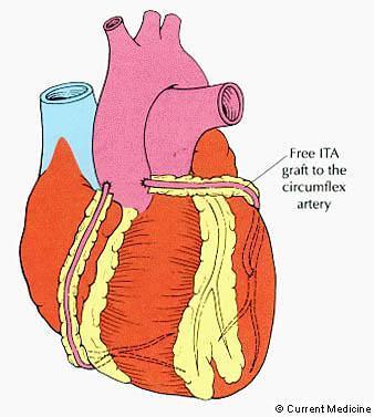 Tratamento Cirúrgico da Coronariopatia Obstrutiva OPÇÕES TÉCNICAS Enxertos arteriais livres