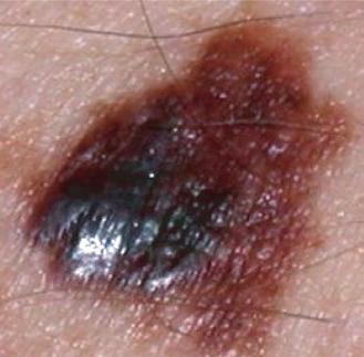 O melanoma maligno pode ser curado se for tratado a tempo. Um atraso no diagnóstico pode supor que se espalhe a outras partes e órgãos do corpo.